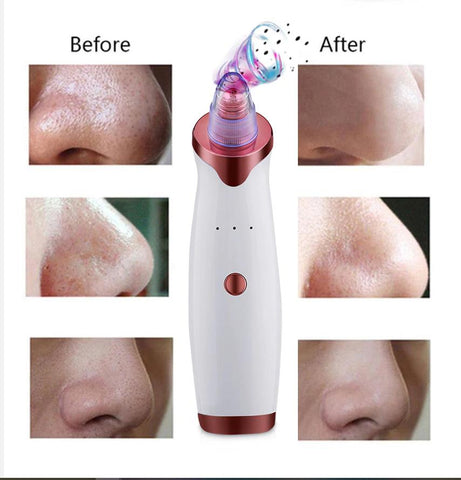 Electric Acne/Blackhead Remover and Vacuum Extractor