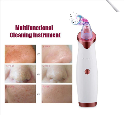 Electric Acne/Blackhead Remover and Vacuum Extractor